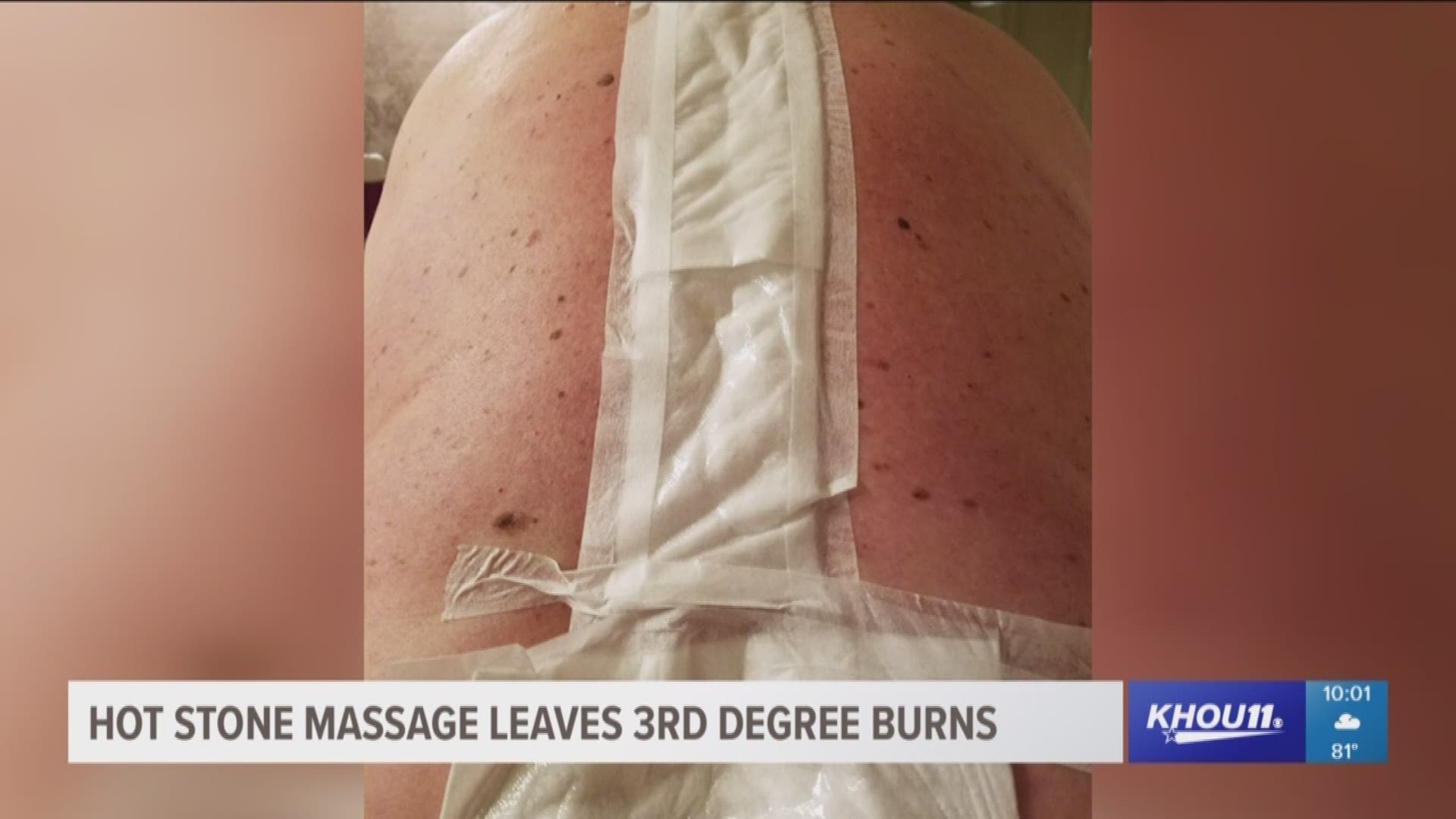 A couple who went into a spa for a massage left with the husband having suffered second- and third-degree burns on his back.