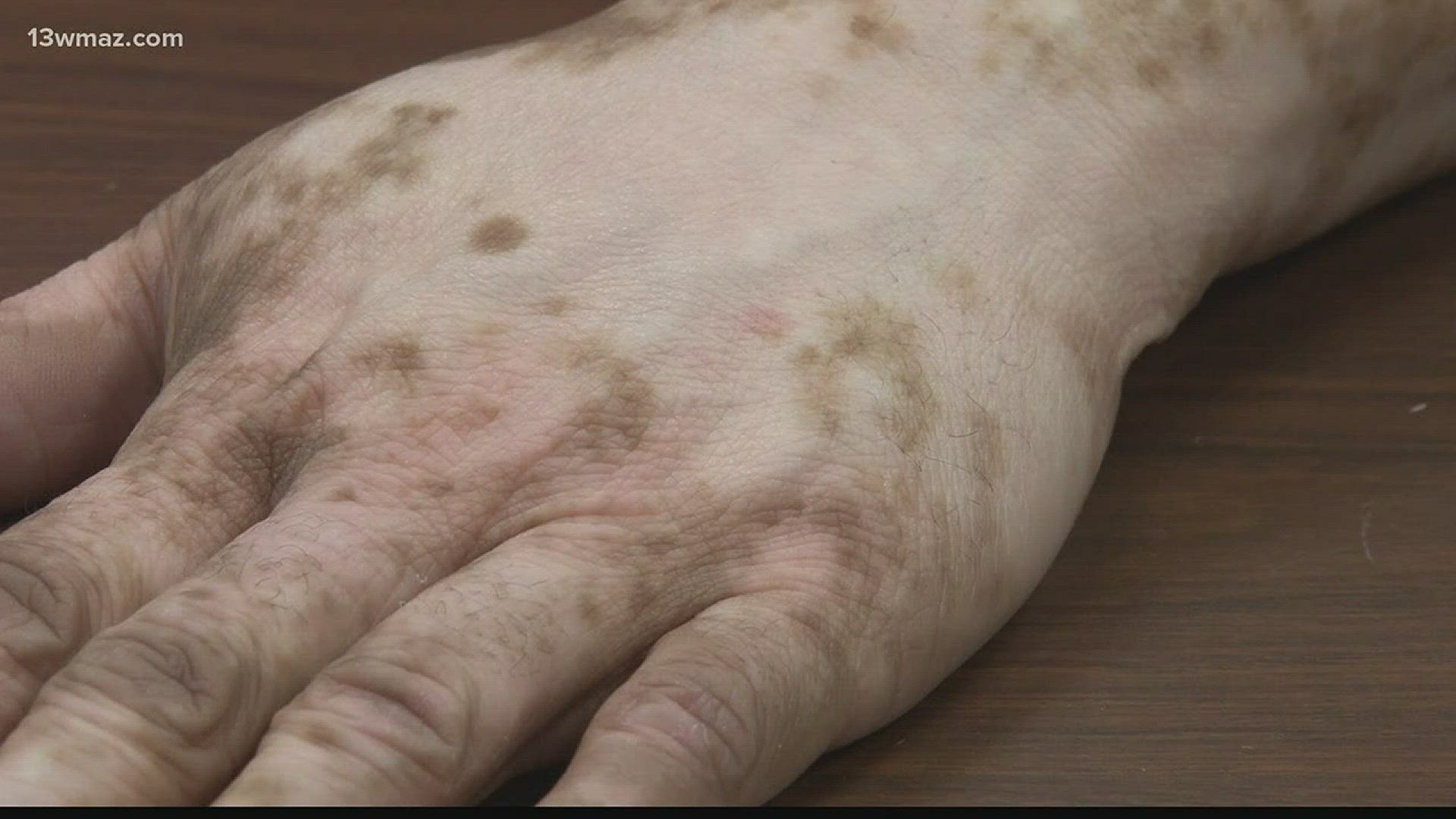 More than 200,000 people living with vitiligo