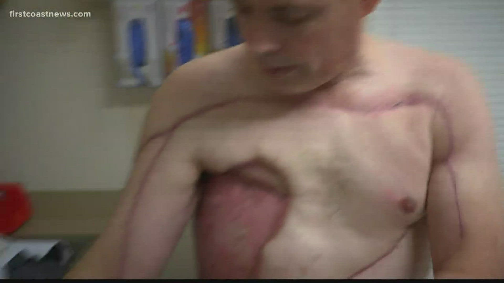 What started out as pain in his shoulder and pectoral muscle turned into a near-fatal infection of flesh-eating bacteria.