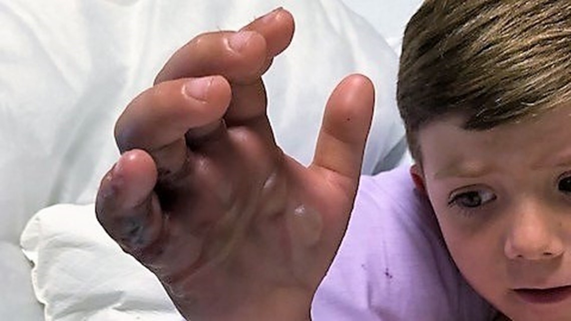 Child's copperhead bite has parents cautioning others Get help immediately